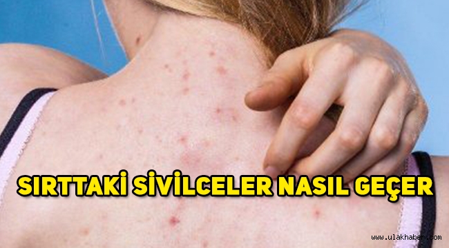 Sırtta çıkan sivilceler nasıl geçer, sırttaki sivilcelerden kurtulma yöntemi?