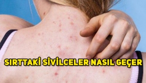 Sırtta çıkan sivilceler nasıl geçer, sırttaki sivilcelerden kurtulma yöntemi?