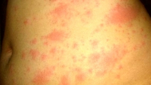 Koronavirüs, deri üzerinde hasar oluşturuyor