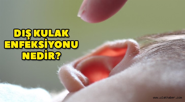 Otitis Eksterna (Dış Kulak Enfeksiyonu) nedir, dış kulak enfeksiyonu nasıl geçer?