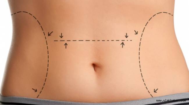 Liposuction zayıflama yöntemi değildir!