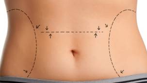 Liposuction zayıflama yöntemi değildir!