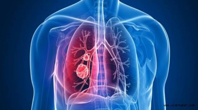 Verem akciğer kanseri ile karıştırılabilir