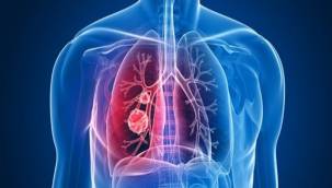 Verem akciğer kanseri ile karıştırılabilir