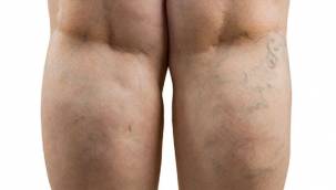 Varis hastalığında dikkat edilmesi gerekenler nelerdir?