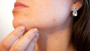 Tedavi edilmeyen sivilceler iz ve lekelere neden olabilir