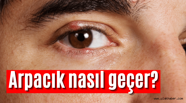 Arpacık nasıl geçer, gözde arpacık neden çıkar, nasıl tedavi edilir doğal bitkisel yöntem!