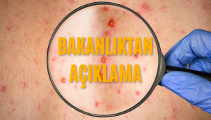 Sağlık Bakanlığı'ndan maymun çiçeği virüsü açıklaması