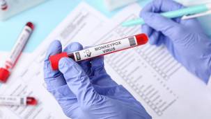 DSÖ, maymun çiçeği için küresel acil durum ilan etti 