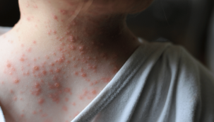 Sağlık Bakanlığı'ndan maymun çiçeği virüsü uyarısı