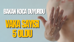 Türkiye'de maymun çiçeği virüsü vakası 5'e yükseldi